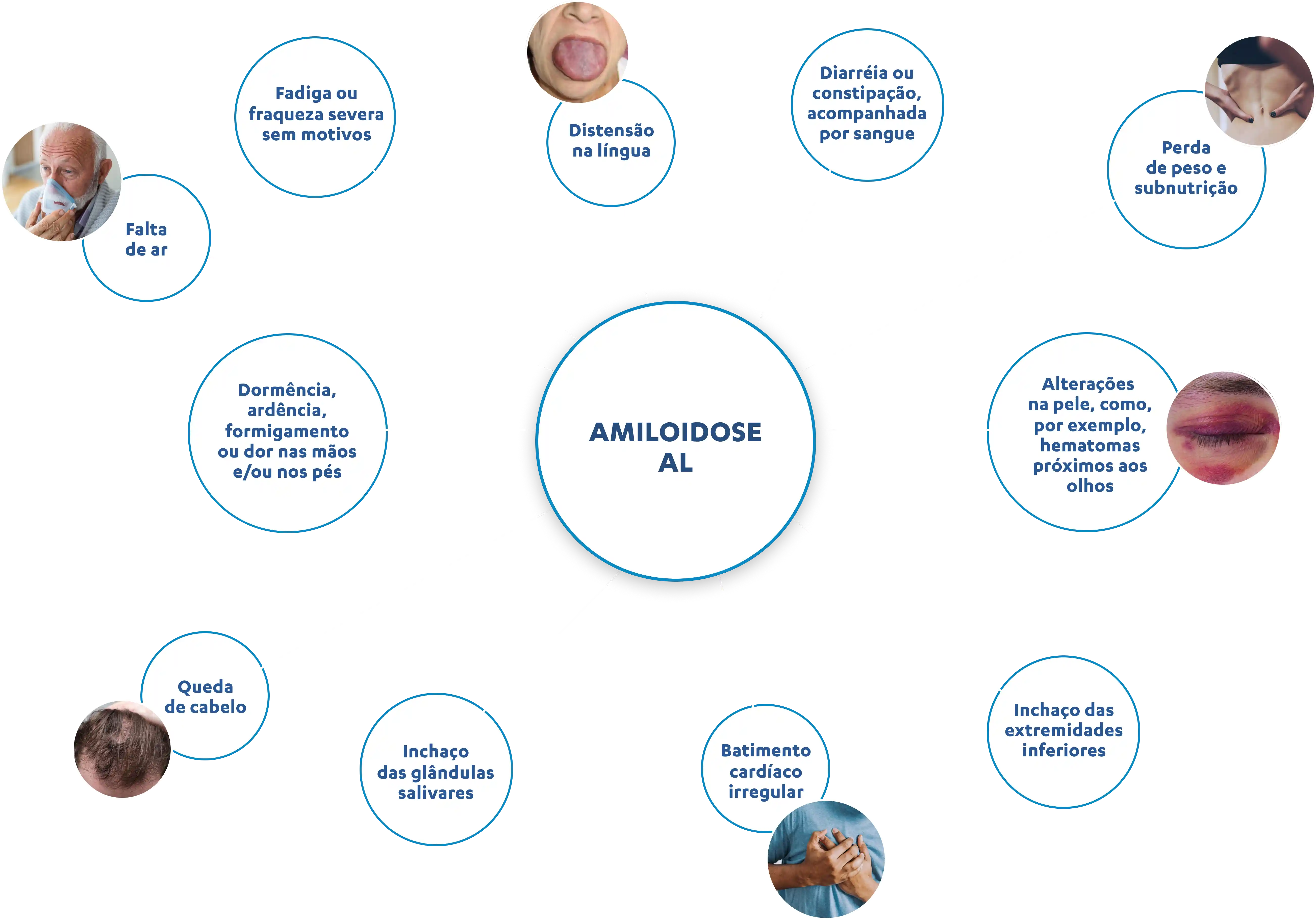 AMILOIDOSE AL: Diarréia ou constipação, acompanhada por sangue; Perda de peso e subnutrição; Alterações  na pele, como, por exemplo, hematomas próximos aos olhos;  Inchaço das extremidades inferiores;  Batimento cardíaco irregular;  Inchaço das glândulas salivares;  Queda de cabelo;  Dormência, ardência, formigamento ou dor nas mãos e/ou nos pés;  Falta de ar;  Fadiga ou fraqueza severa sem motivos;  Distensão na língua;